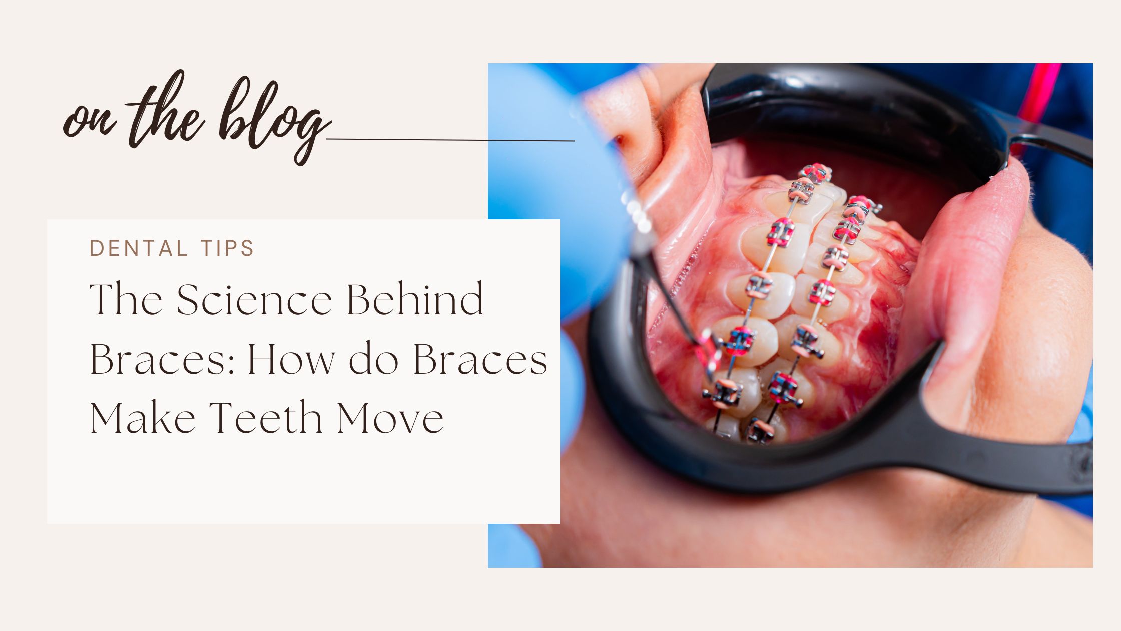 Science Behind Braces